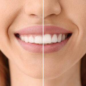Sonrisa gingival